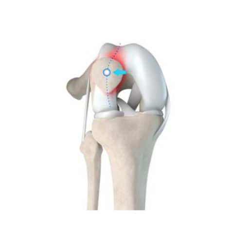 Imagen resonancia de rótula inestable