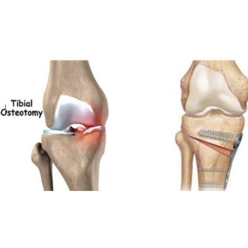 Osteotomía de Rodilla