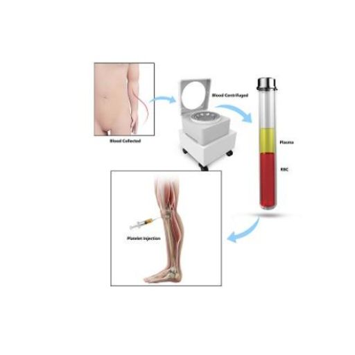 Plasma rico en plaquetas