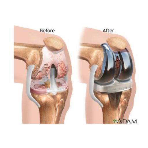 Cirugía de reemplazo total de rodilla por el Dr. Fabián Poletti en Marbella