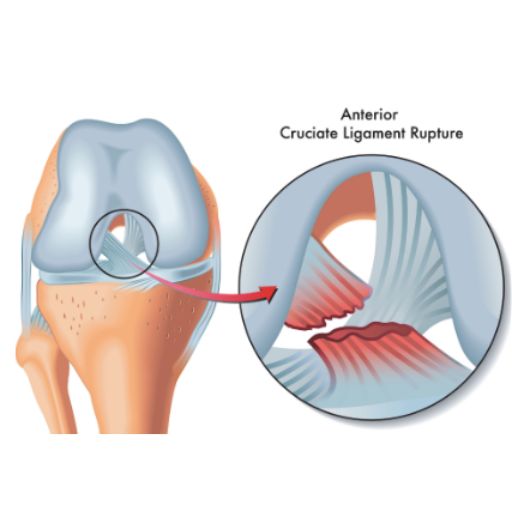 Reconstrucción de ligamentos