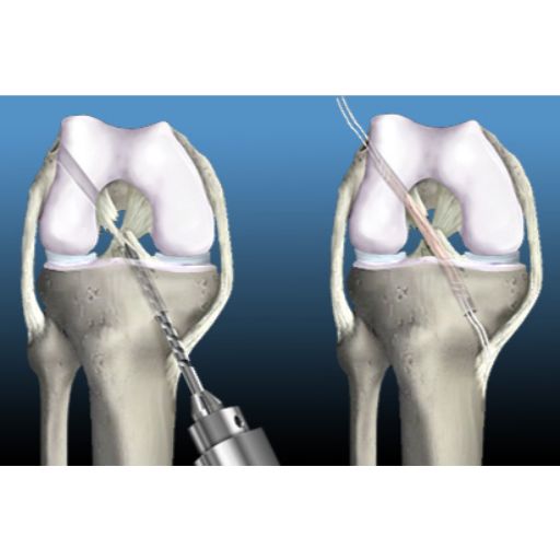 Recostruccion de ligamentos