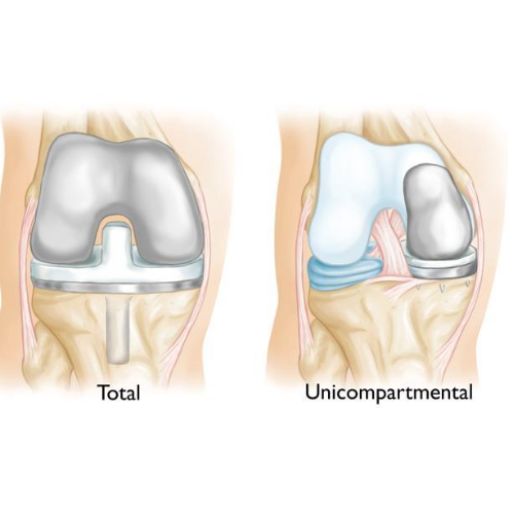 Imagen de prótesis parcial de rodilla